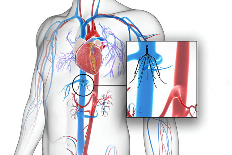 Kavální filtry a jejich místo v současné kardiologii
